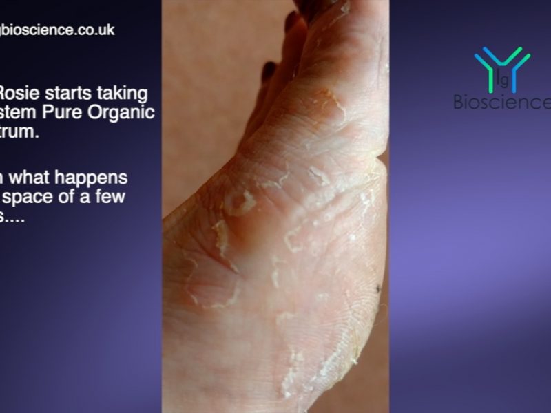 STUNNING RESULTS WITH ECZEMA A VIDEO DIARY IgBioscience