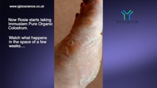 Stunning results with Eczema- a video diary